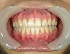 舌側ワイヤー矯正　症例（1）