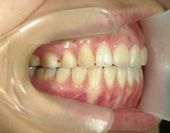 舌側ワイヤー矯正　症例（1）