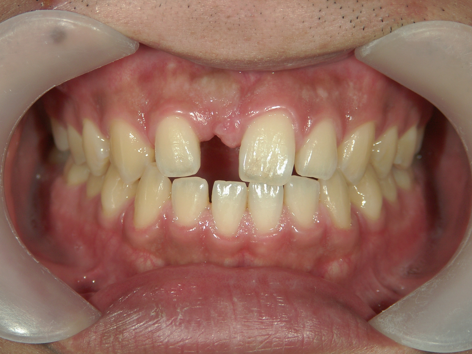 前歯抜歯閉鎖症例 治療例（1） 右上中切歯欠損→歯冠移動後、空隙にインプラントOPE