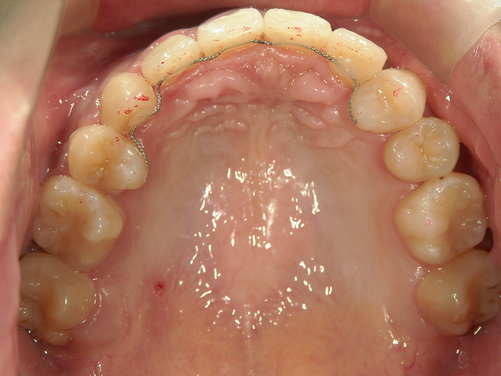 全顎ワイヤー矯正　症例（6）