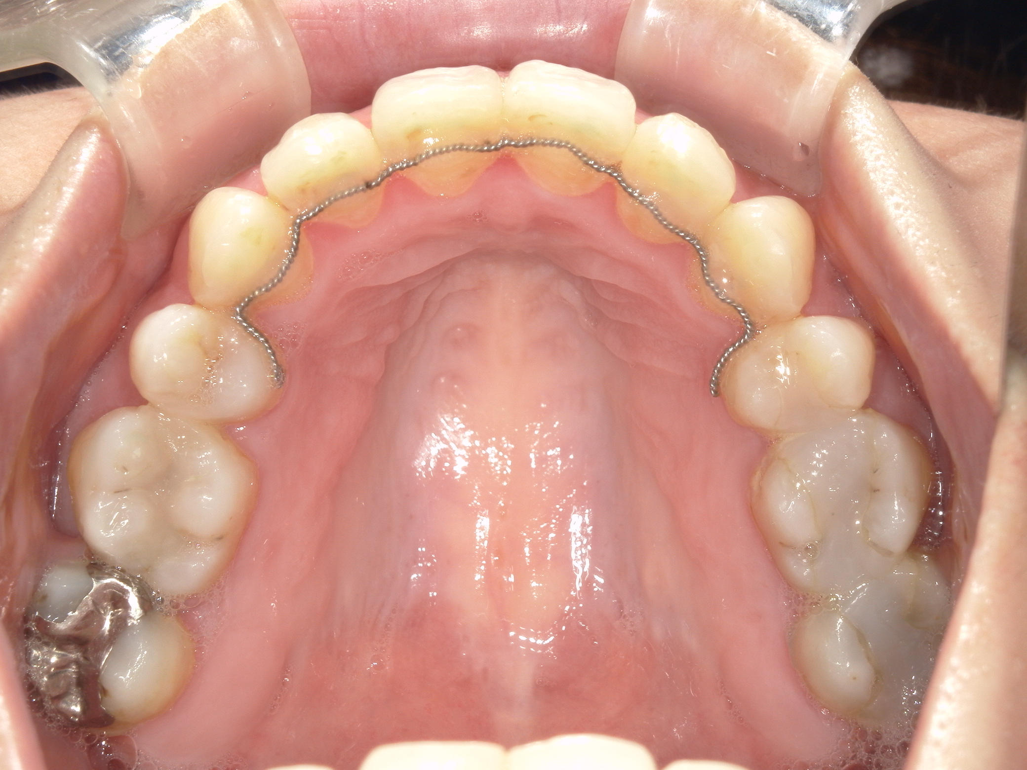 舌側ワイヤー矯正　症例（3）