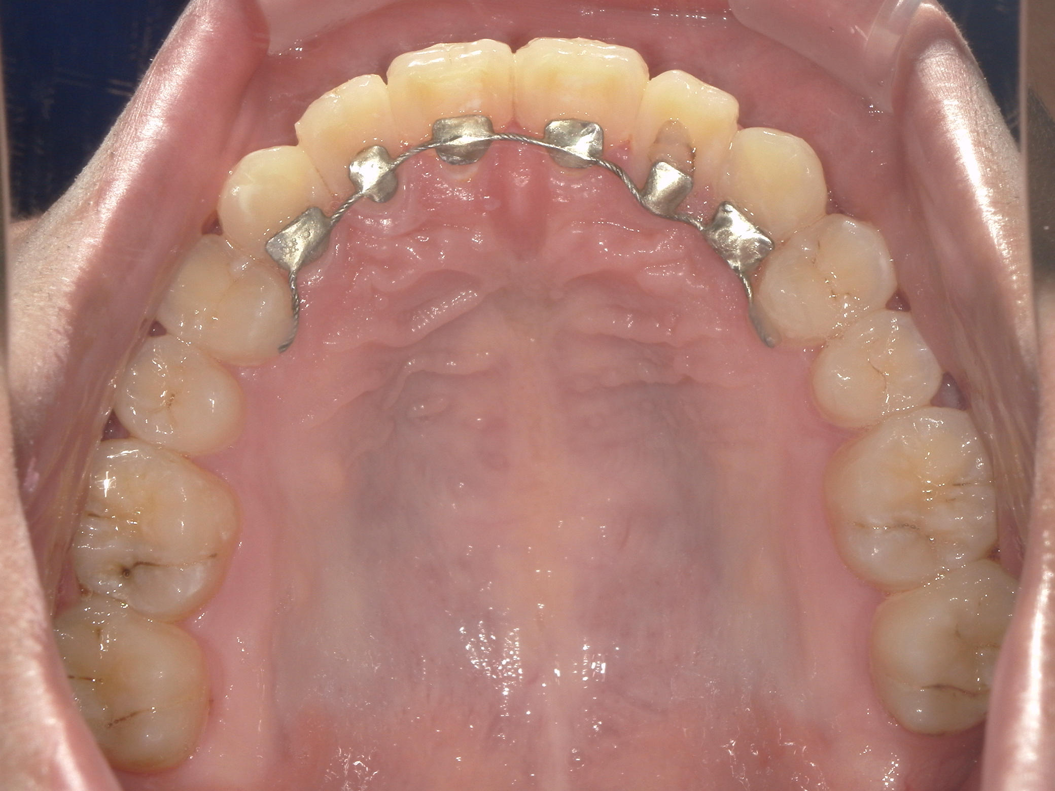 全顎ワイヤー矯正　症例（8）