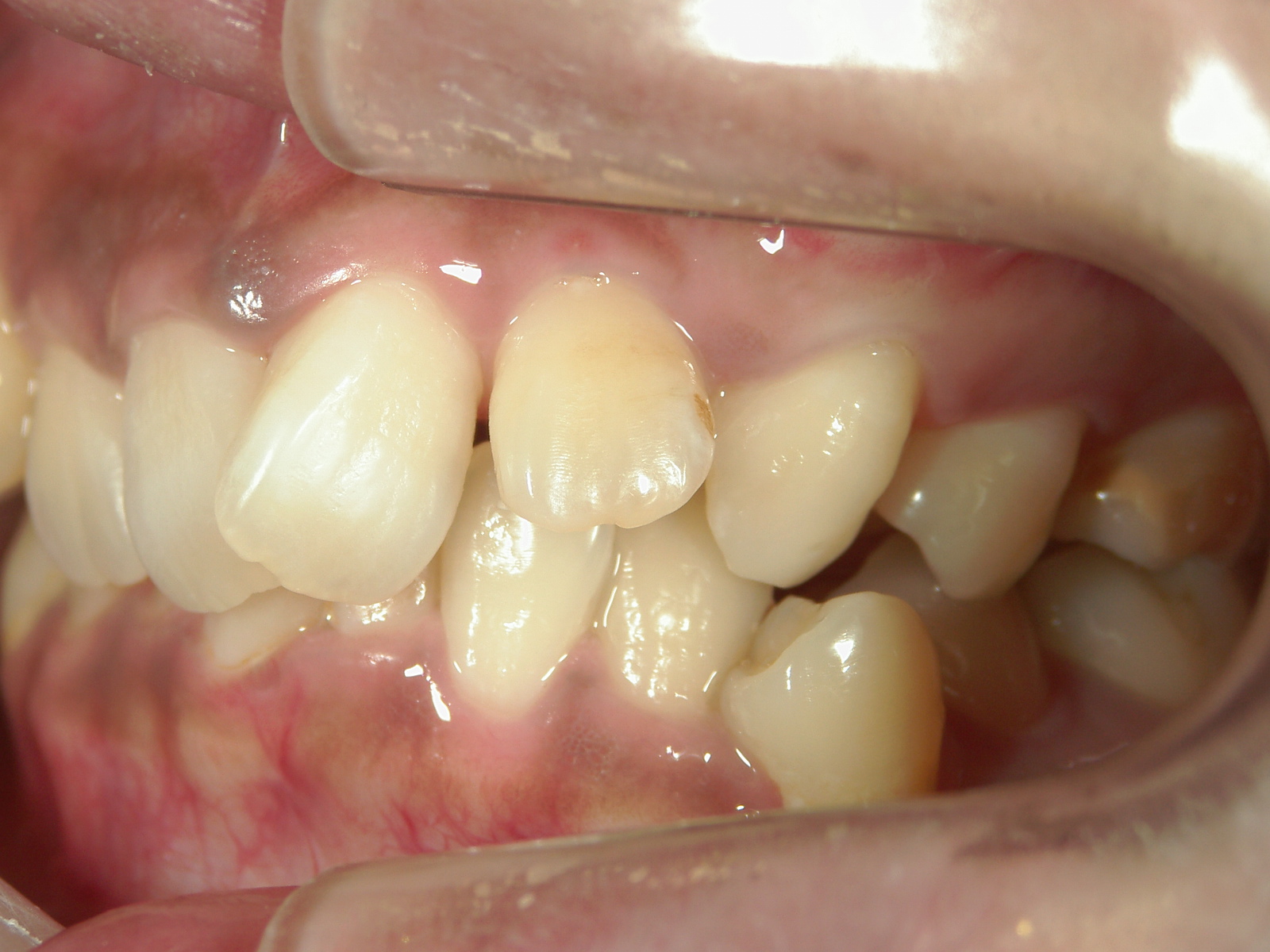 全顎ワイヤー矯正　症例（6）