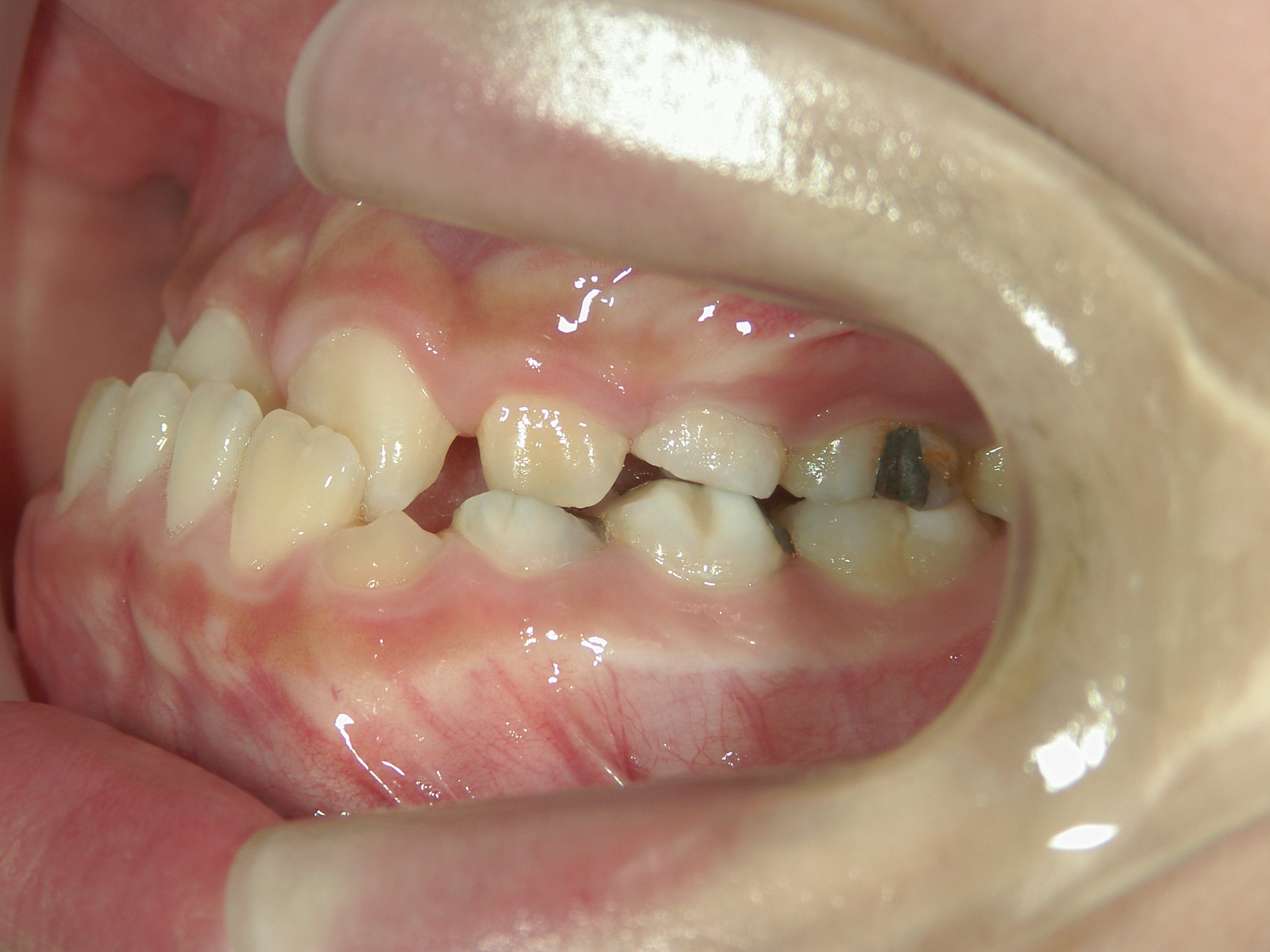 全顎ワイヤー矯正　症例（8）