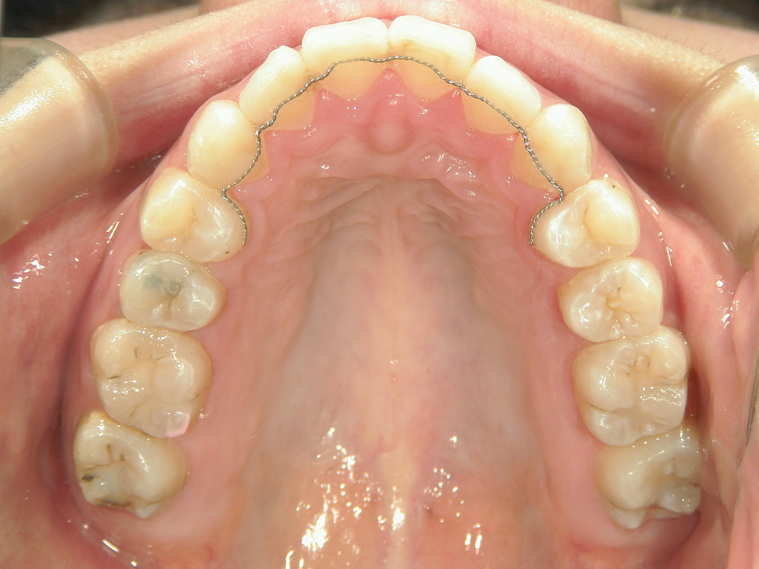 舌側ワイヤー矯正　症例（2）