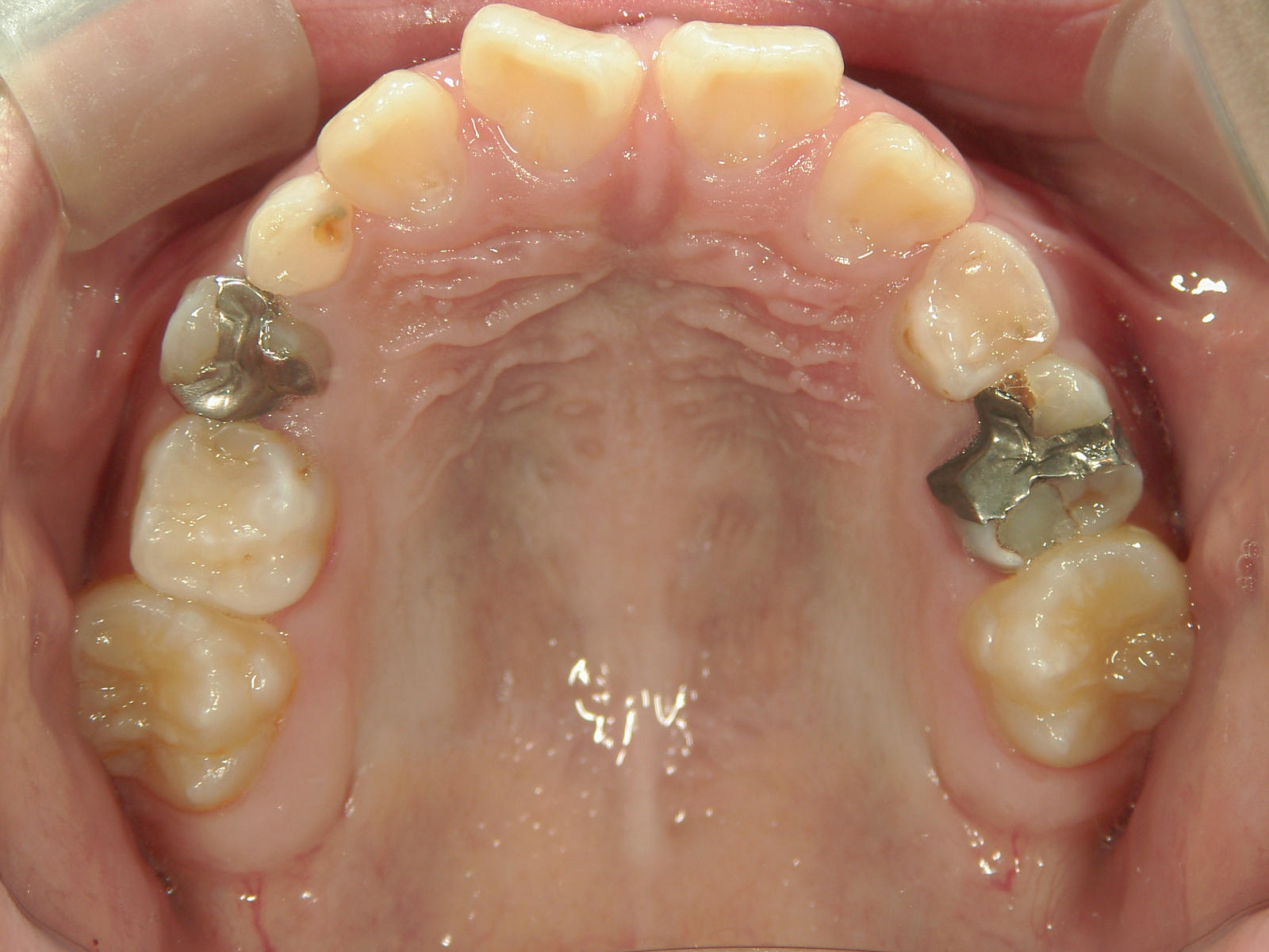 全顎ワイヤー矯正　症例（8）