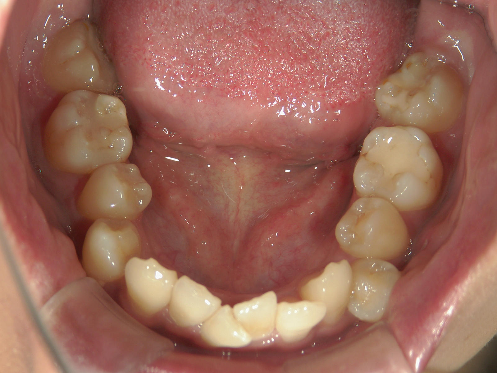 全顎ワイヤー矯正　症例（6）