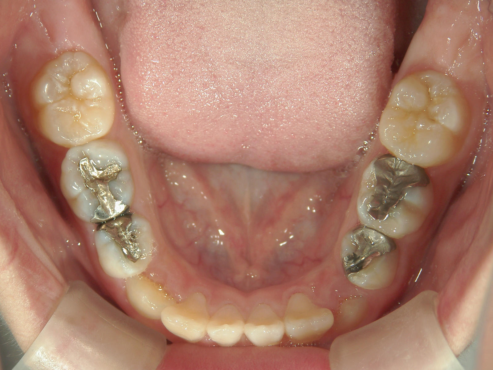 全顎ワイヤー矯正　症例（8）