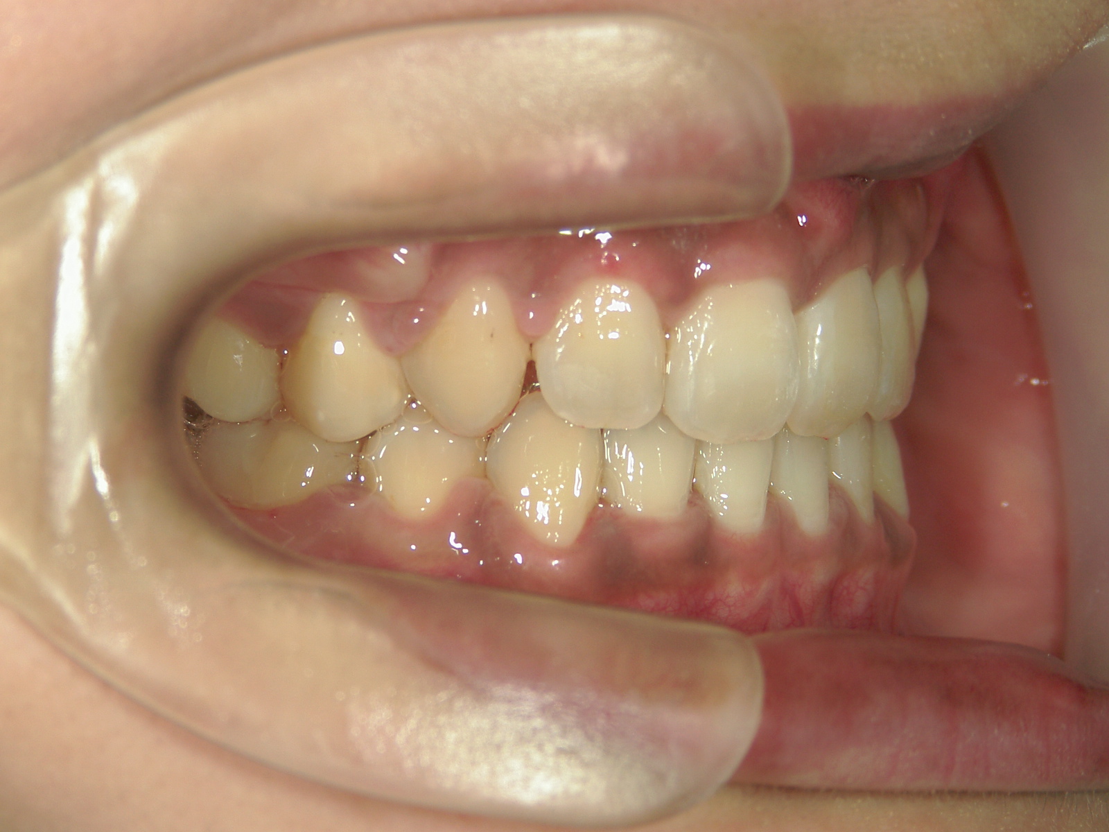 全顎ワイヤー矯正　症例（6）