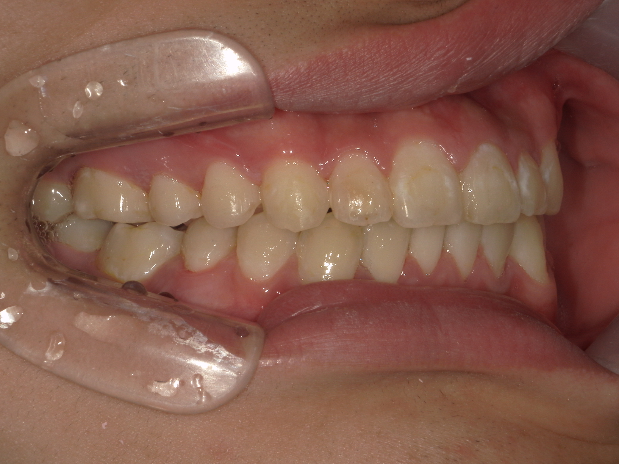 全顎ワイヤー矯正　症例（8）