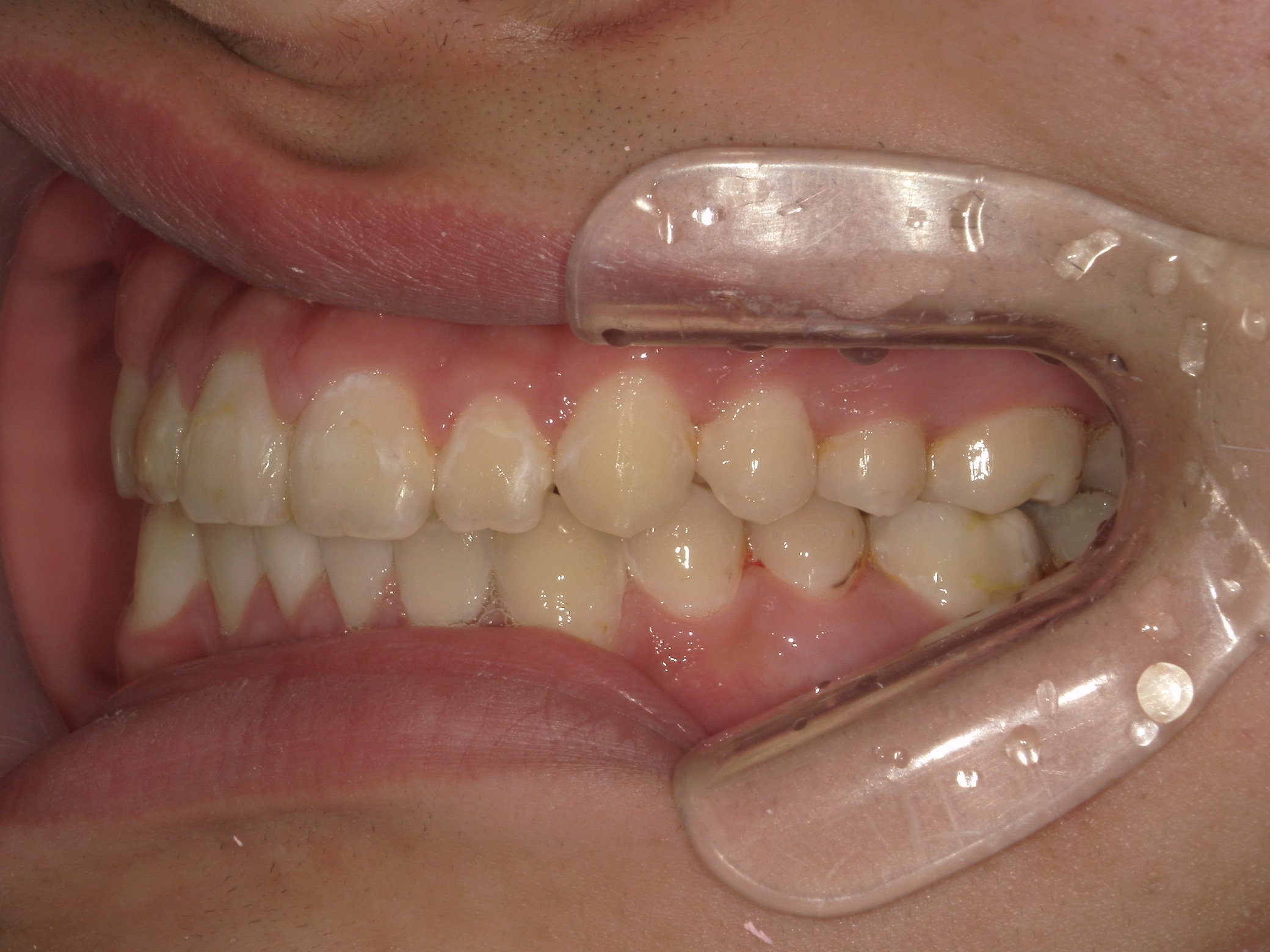 全顎ワイヤー矯正　症例（8）