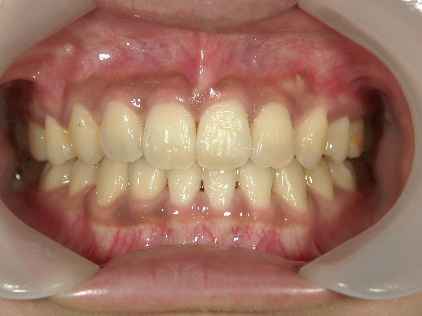 全顎ワイヤー矯正　症例（6）