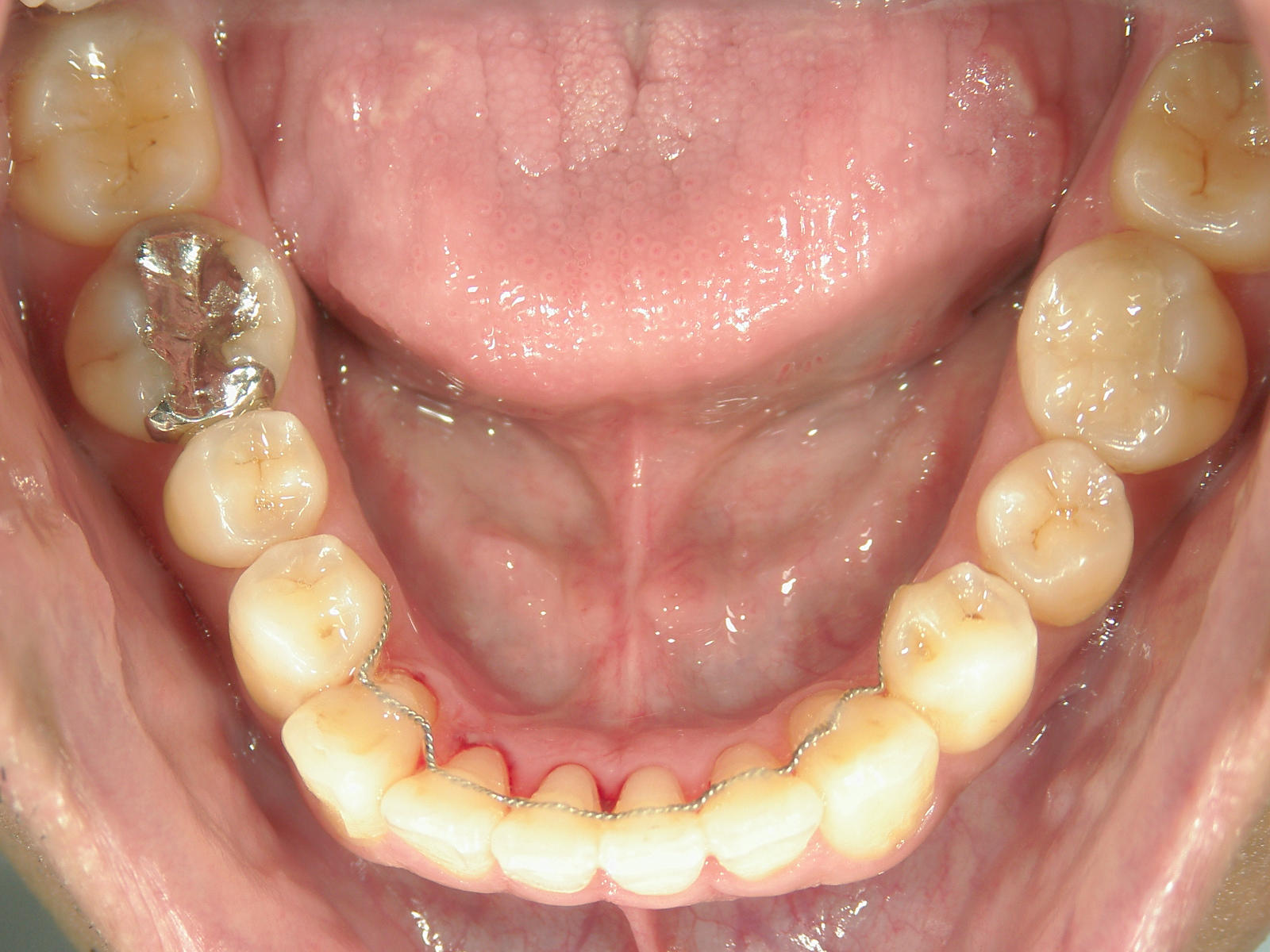 プチ舌側ワイヤー矯正　症例（6）