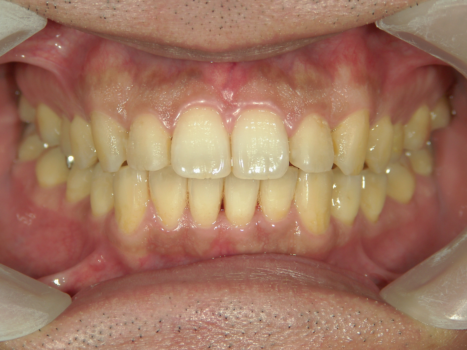 プチ舌側ワイヤー矯正　症例（6）