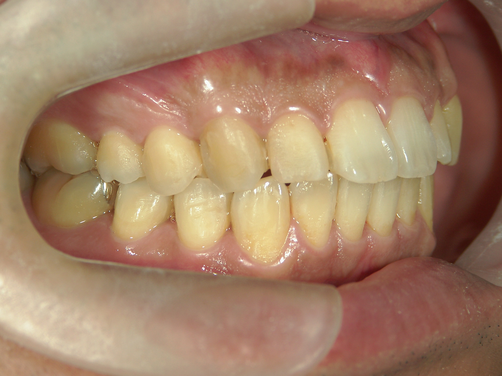 プチ舌側ワイヤー矯正　症例（6）