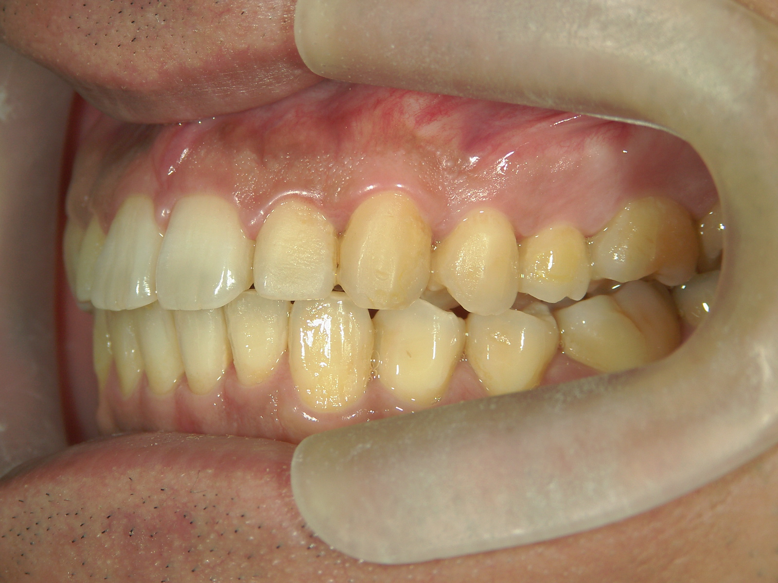 プチ舌側ワイヤー矯正　症例（6）