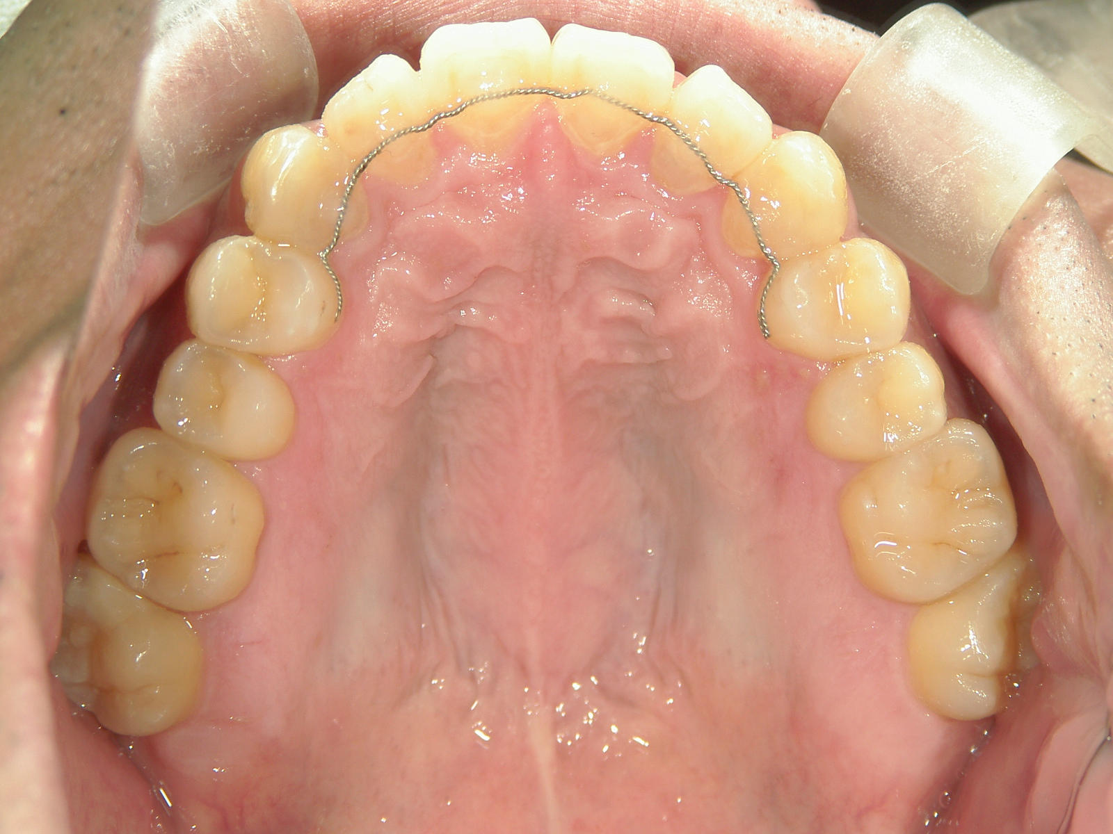 プチ舌側ワイヤー矯正　症例（6）