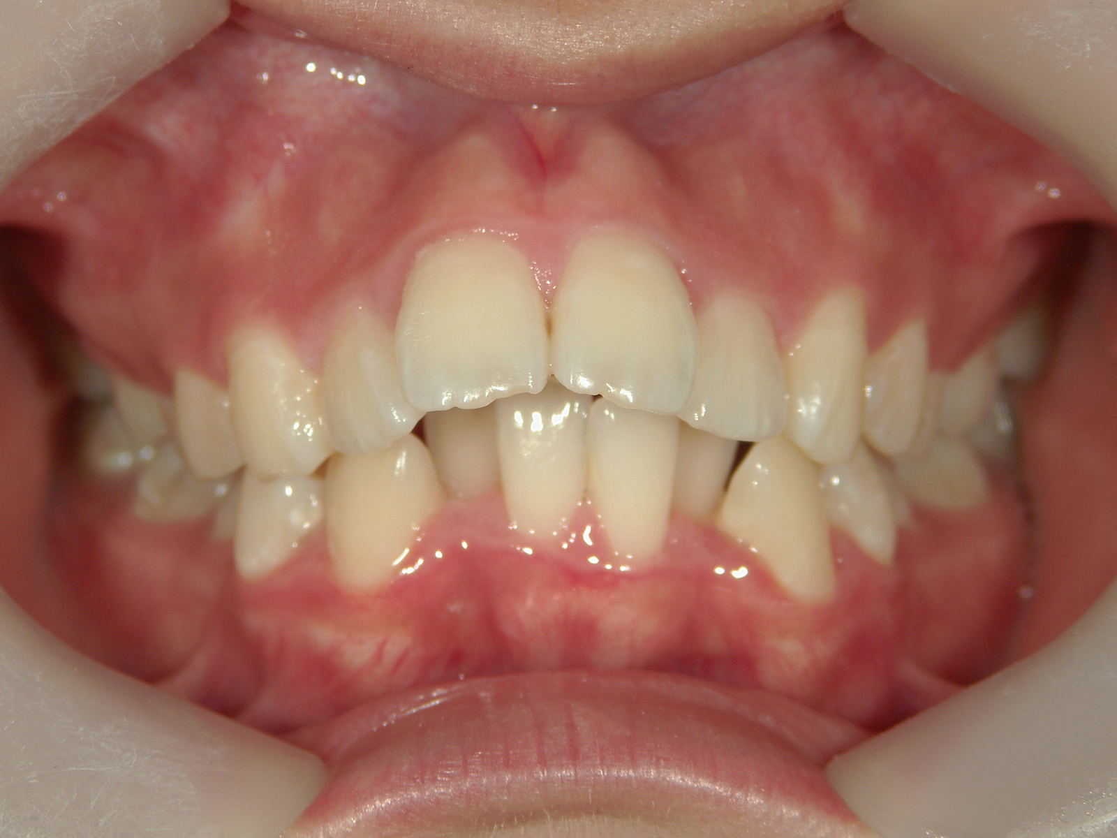 舌側ワイヤー矯正　症例（2）
