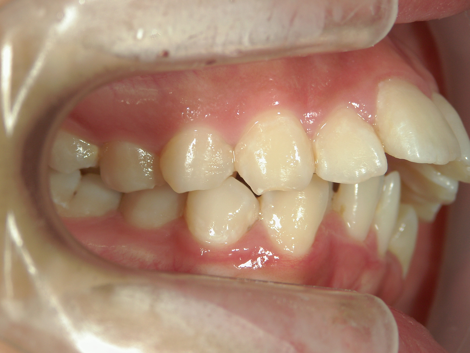 舌側ワイヤー矯正　症例（2）