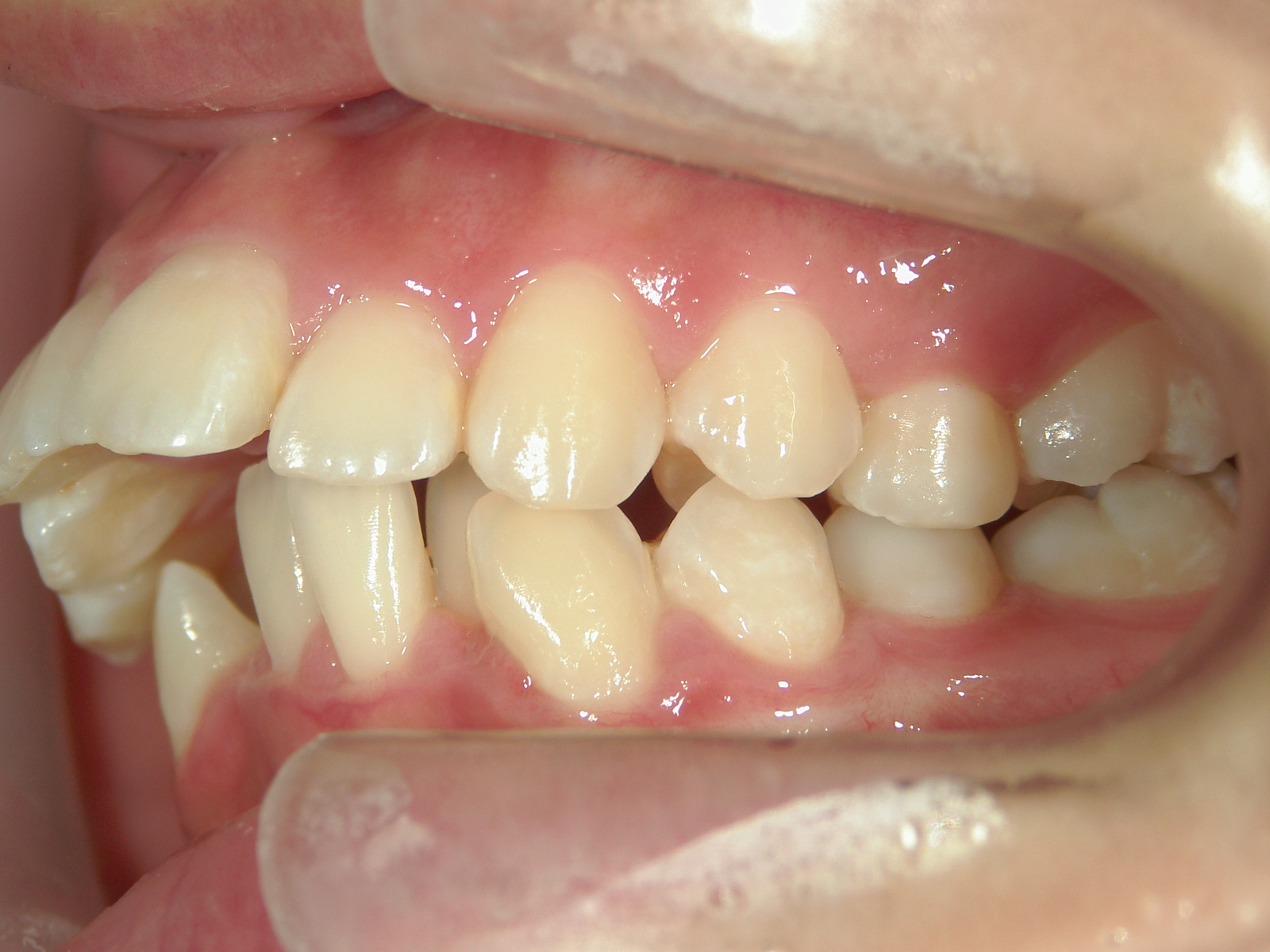 舌側ワイヤー矯正　症例（2）