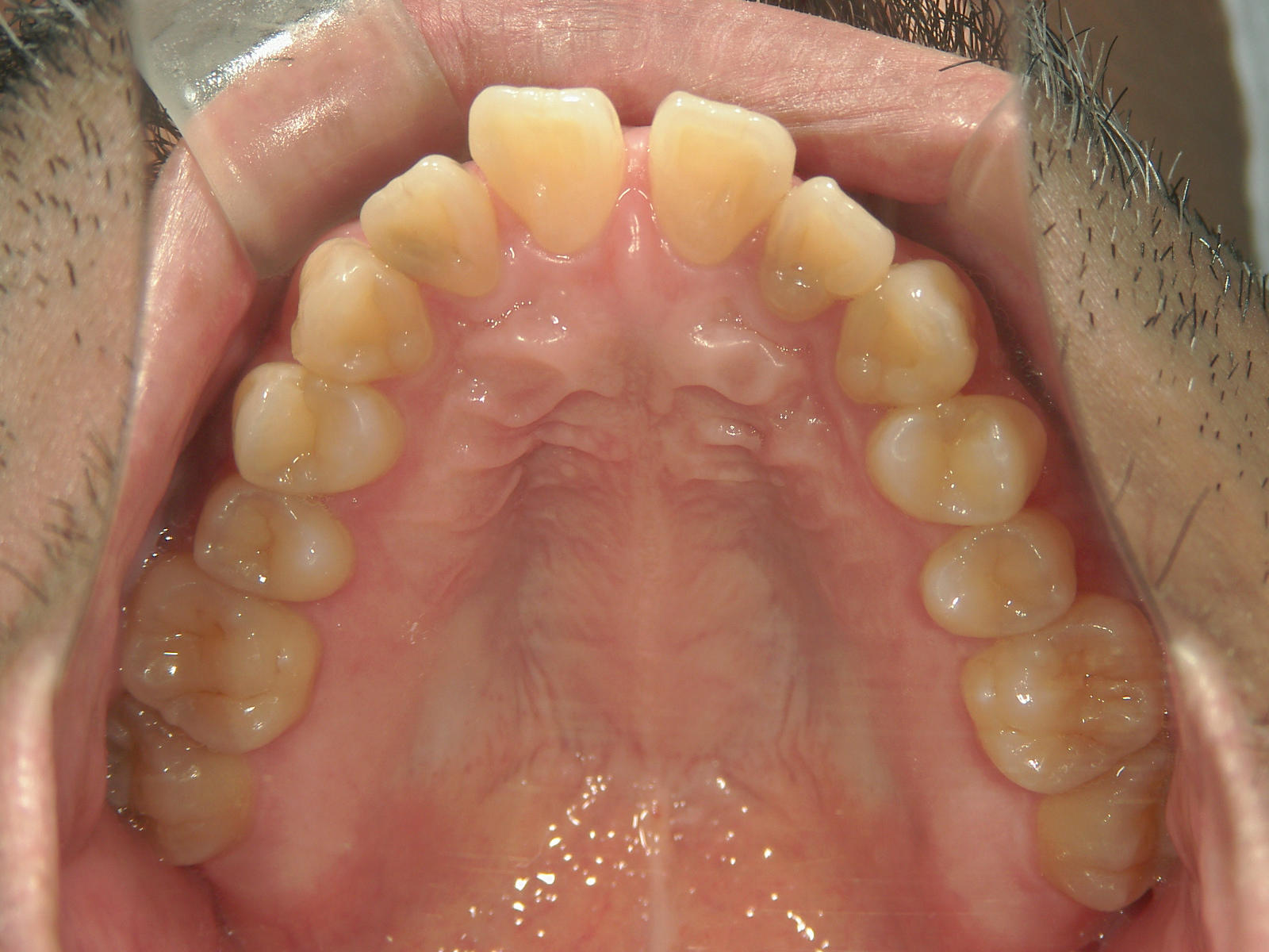 プチ舌側ワイヤー矯正　症例（6）