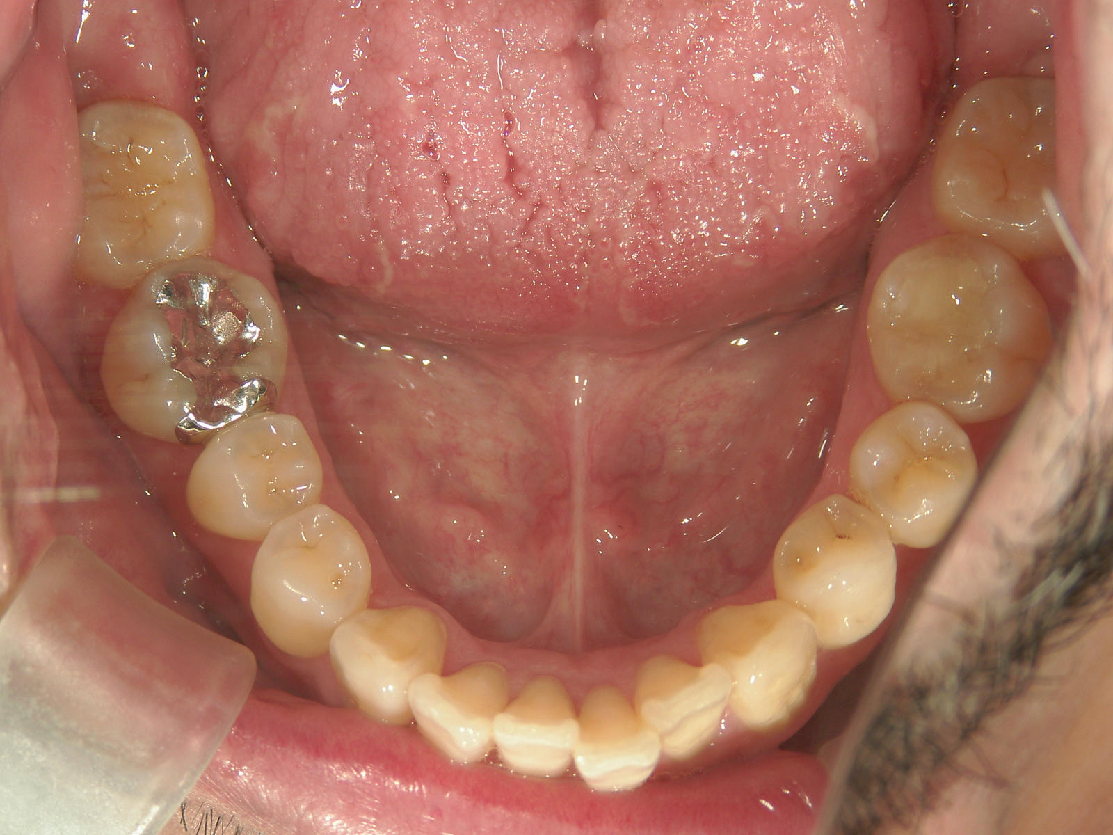 プチ舌側ワイヤー矯正　症例（6）