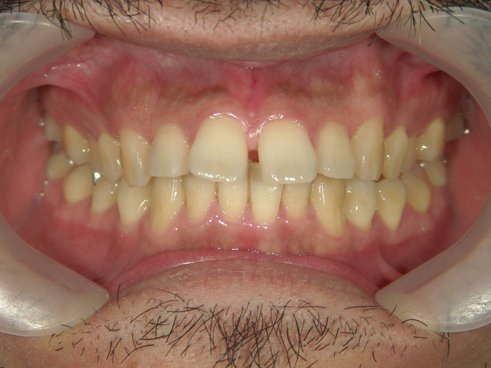 プチ舌側ワイヤー矯正　症例（6）