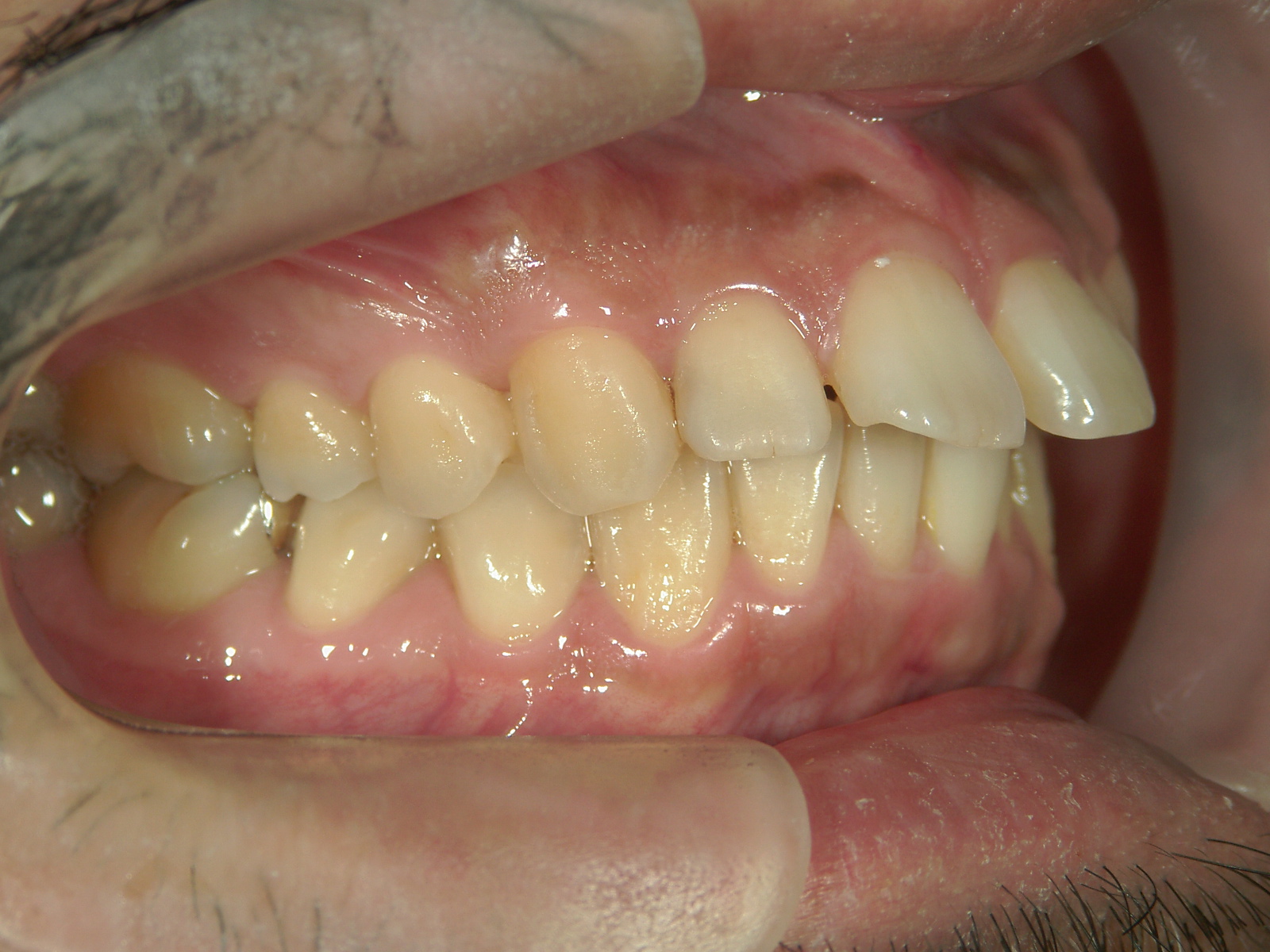 プチ舌側ワイヤー矯正　症例（6）