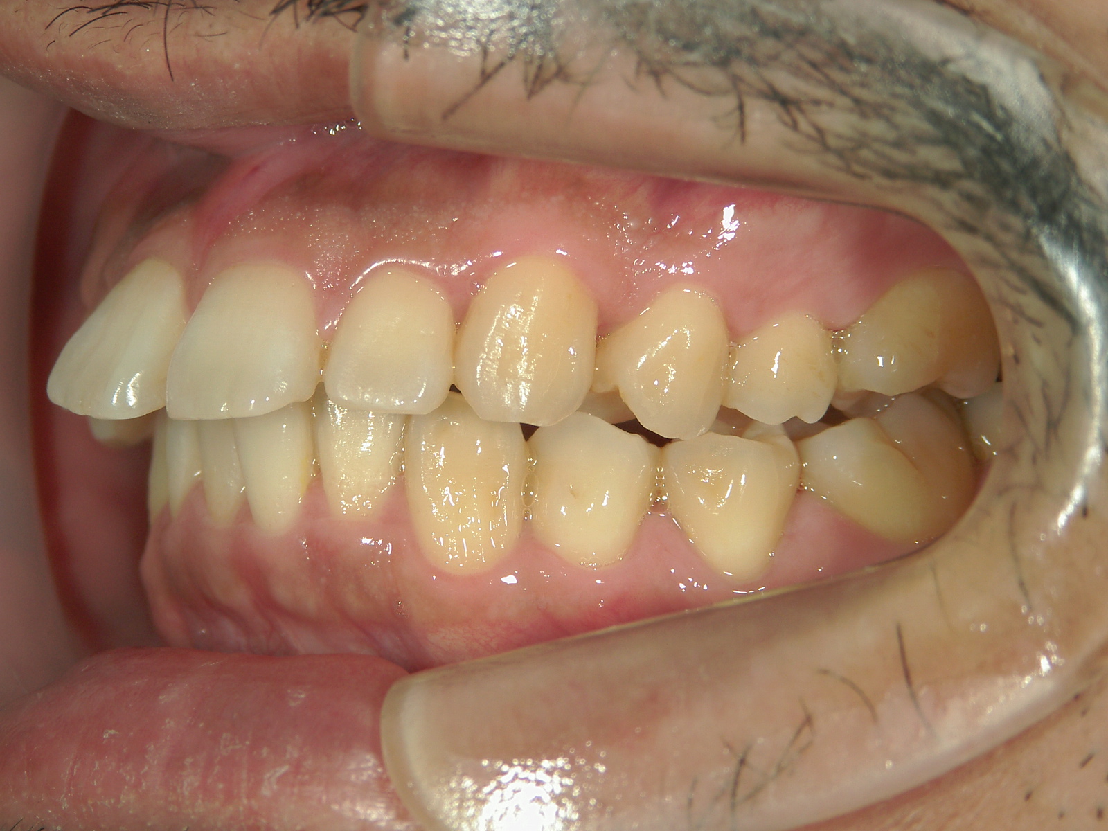 プチ舌側ワイヤー矯正　症例（6）