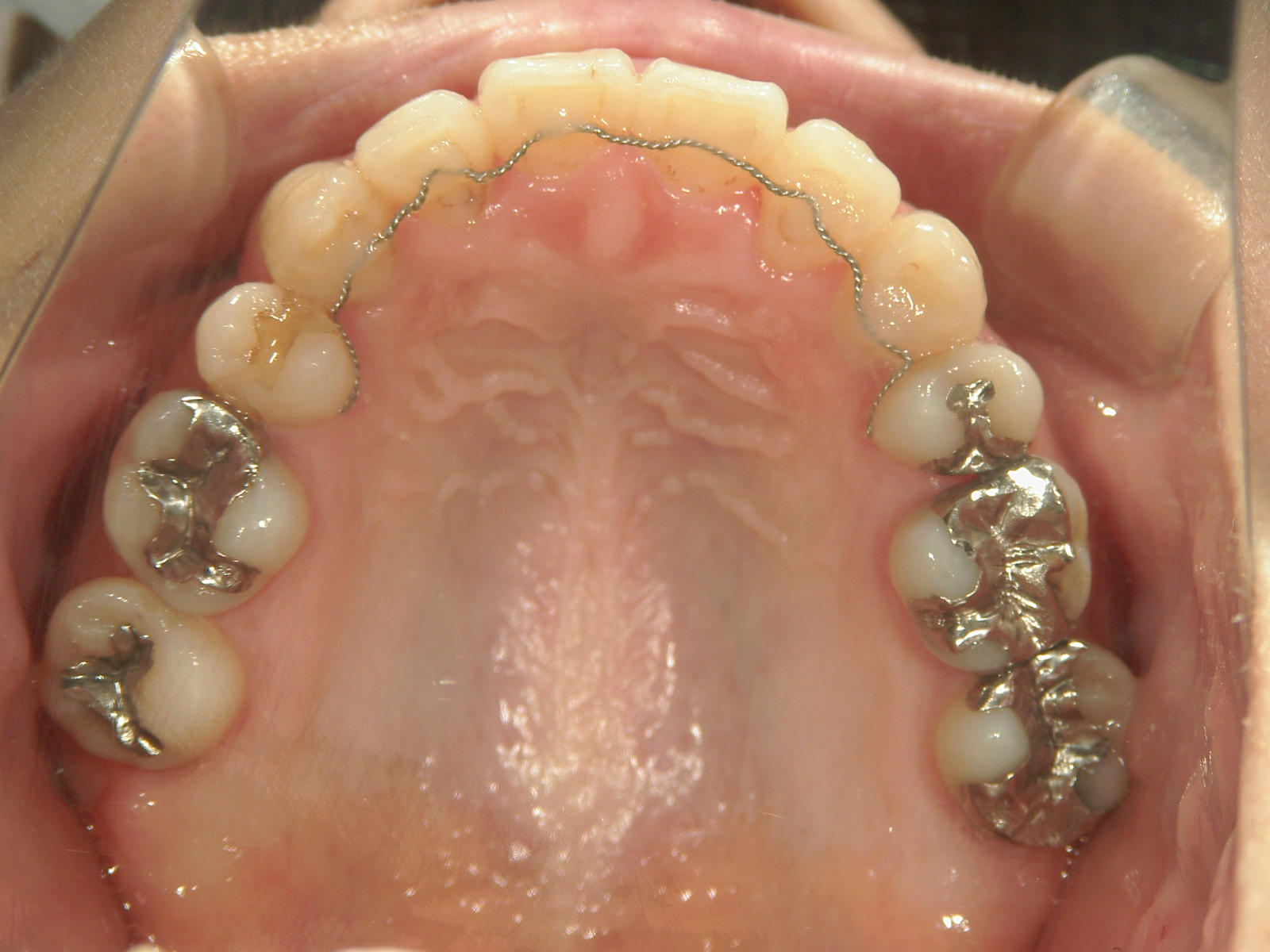 全顎ワイヤー矯正　症例（4）