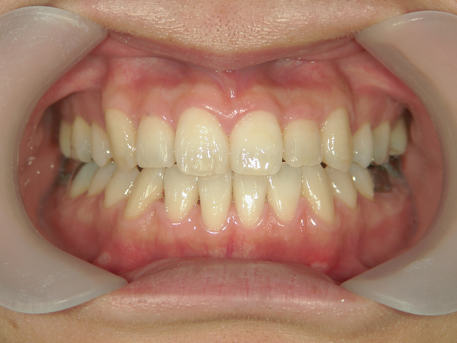 全顎ワイヤー矯正　症例（4）