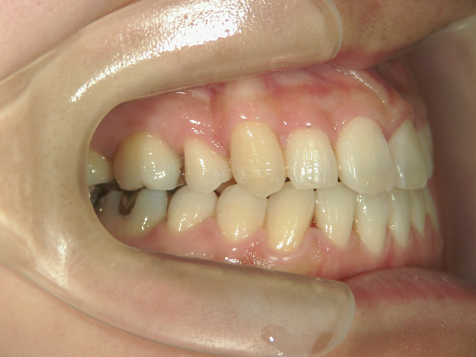 全顎ワイヤー矯正　症例（4）