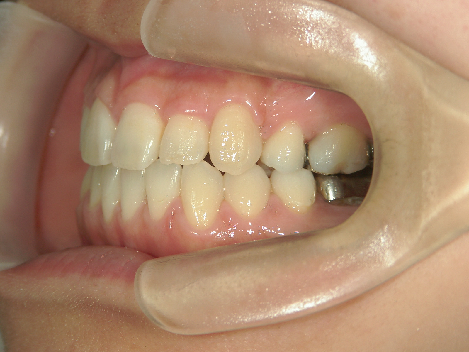 全顎ワイヤー矯正　症例（4）