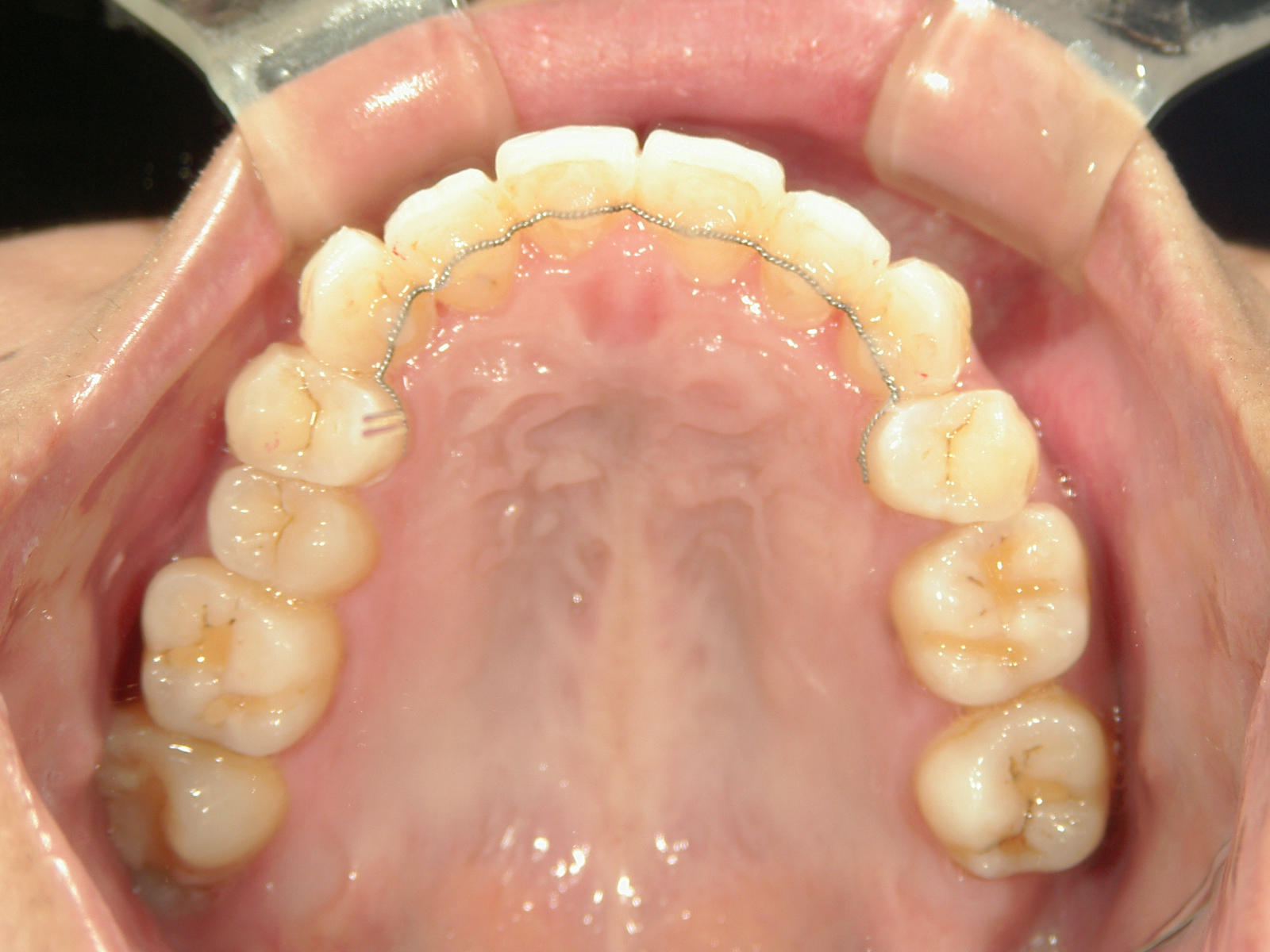 プチ舌側ワイヤー矯正　症例（5）