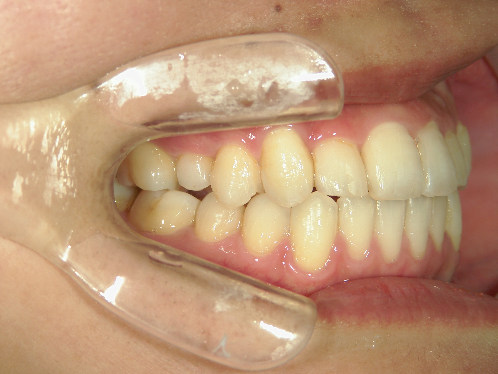 プチ舌側ワイヤー矯正　症例（5）