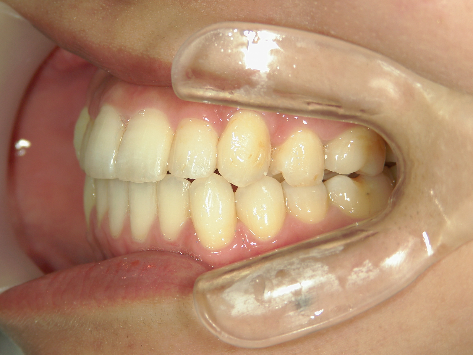 プチ舌側ワイヤー矯正　症例（5）