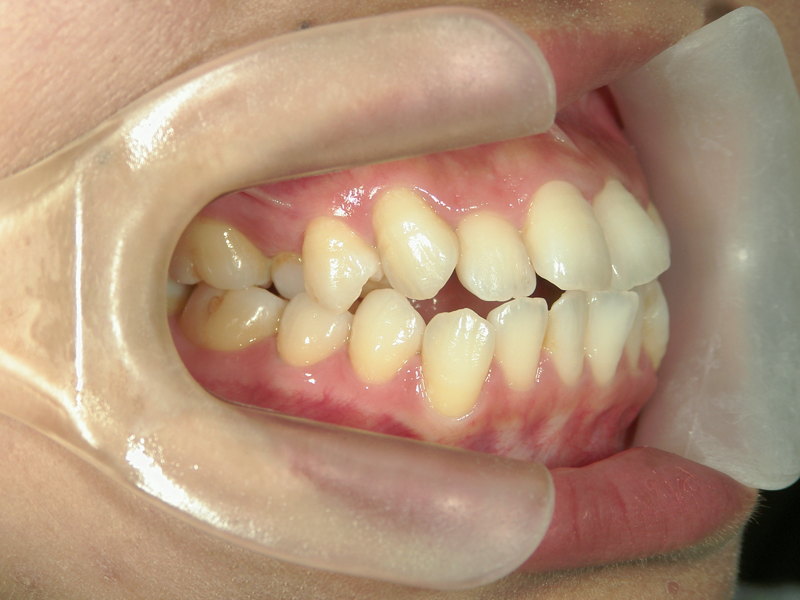 プチ舌側ワイヤー矯正　症例（5）