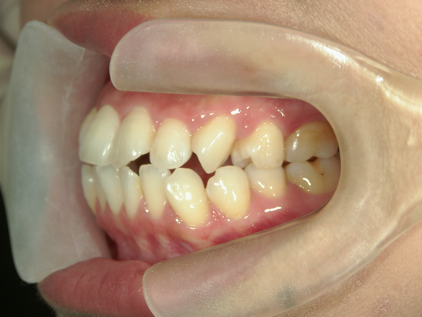 プチ舌側ワイヤー矯正　症例（5）