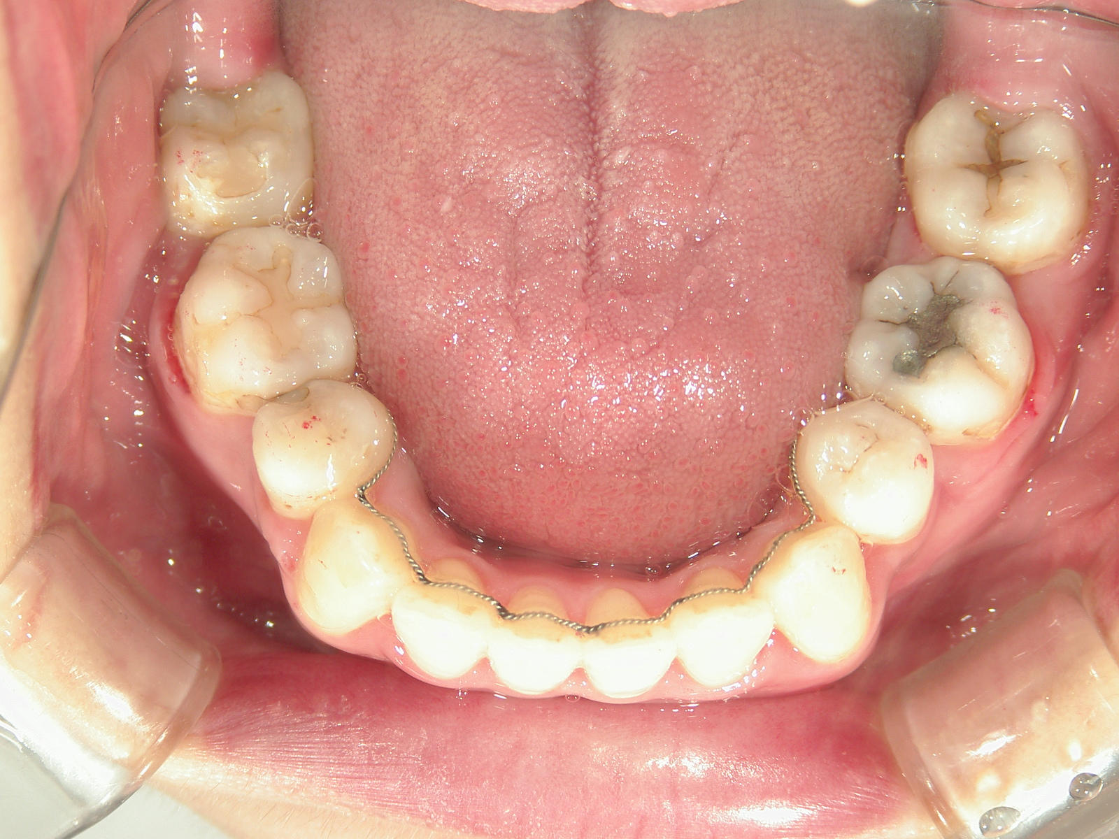 舌側ワイヤー矯正　症例（3）