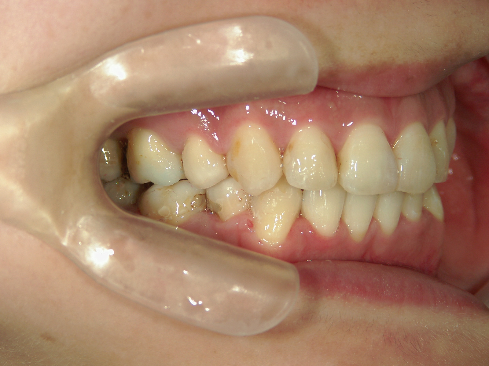 舌側ワイヤー矯正　症例（3）