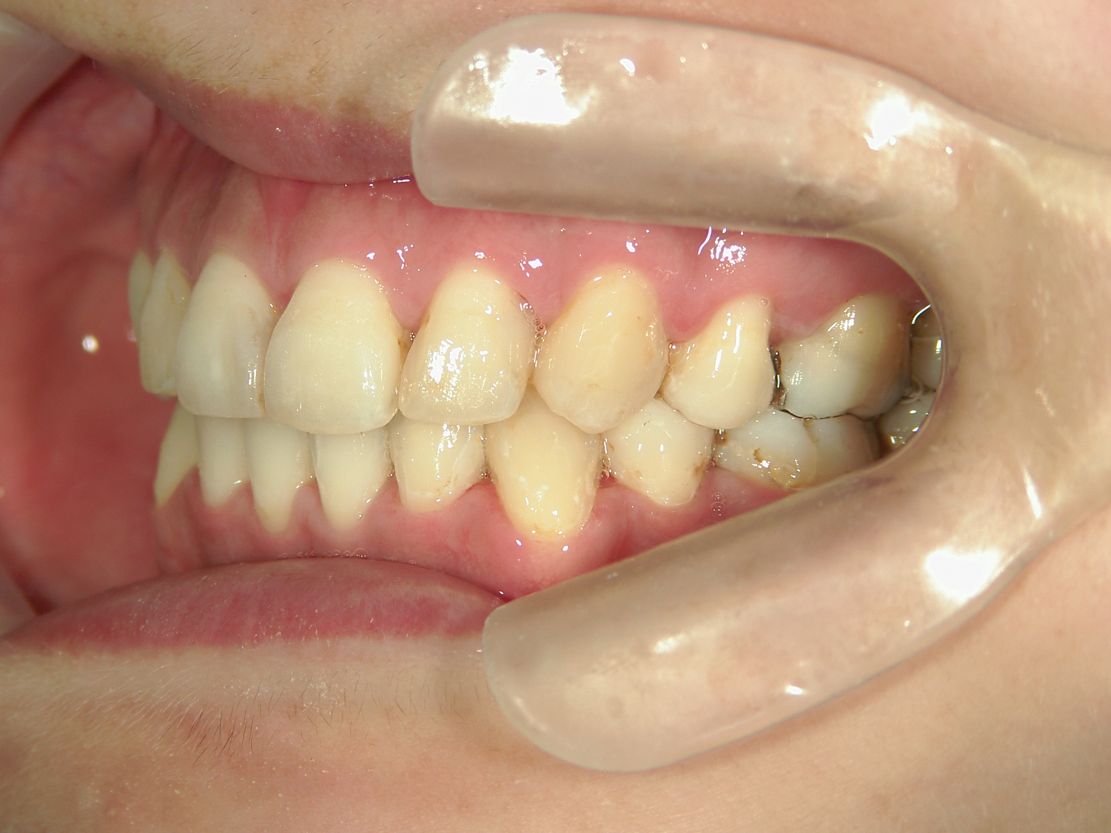 舌側ワイヤー矯正　症例（3）