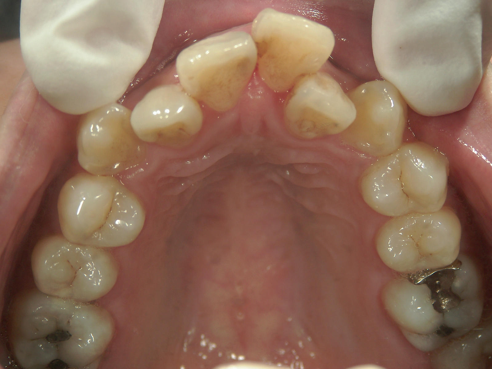 舌側ワイヤー矯正　症例（3）