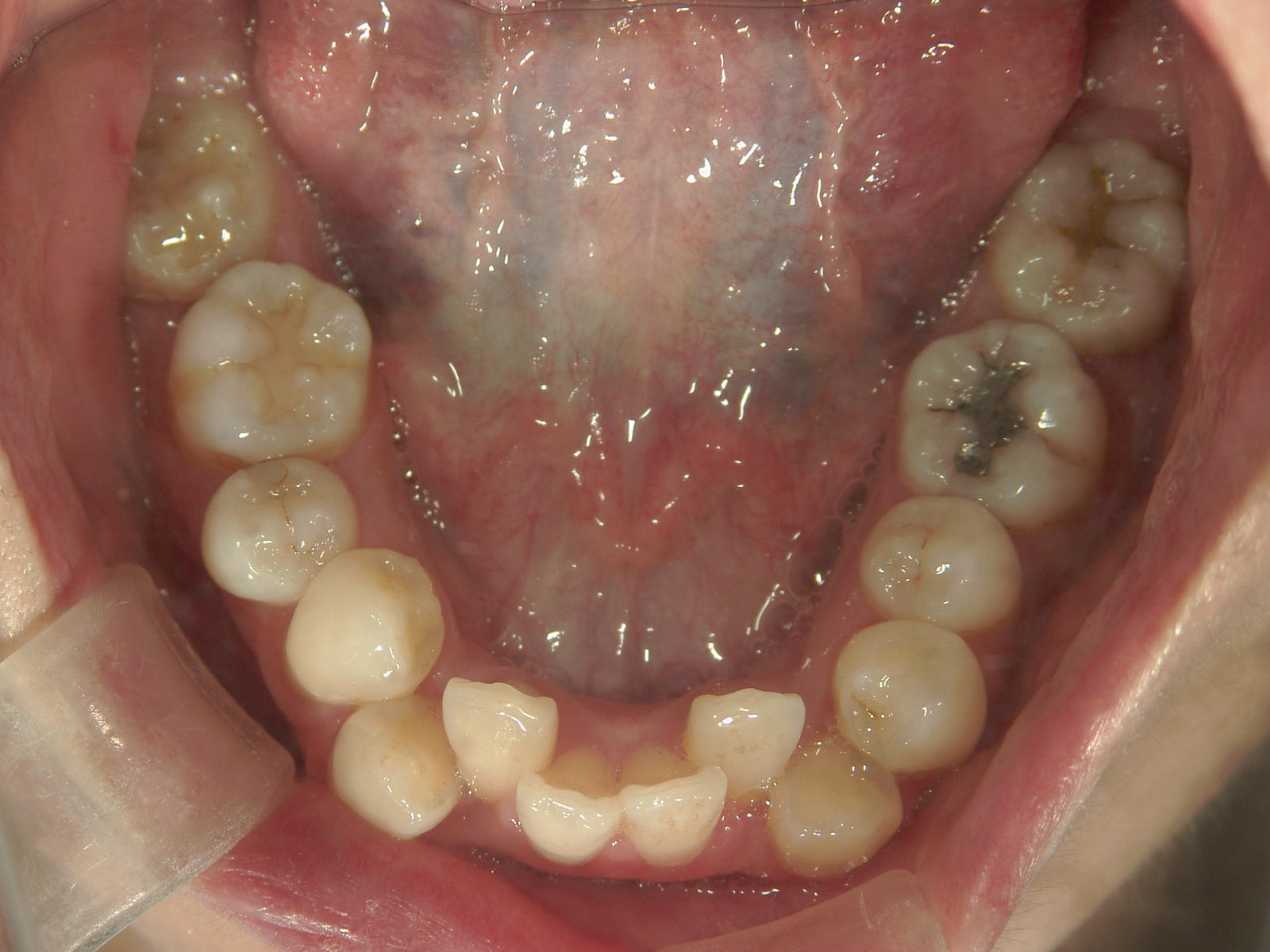 舌側ワイヤー矯正　症例（3）