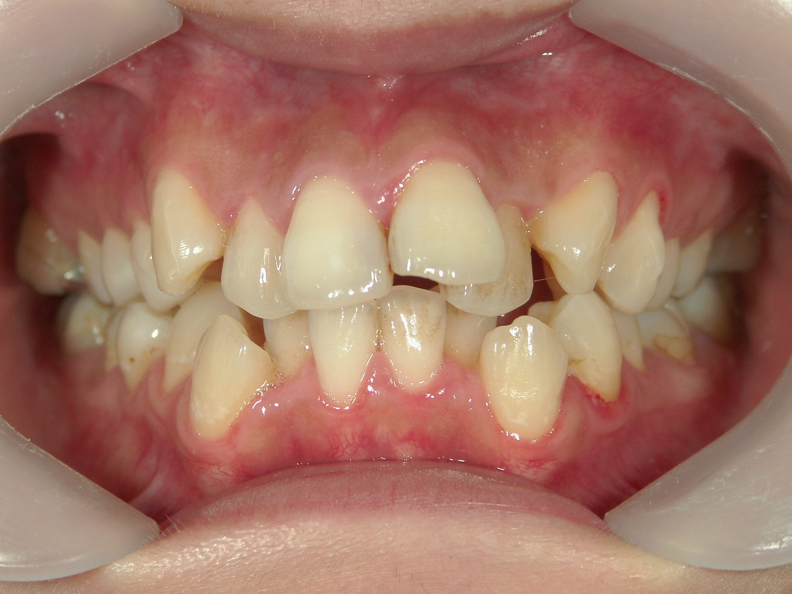 舌側ワイヤー矯正　症例（3）