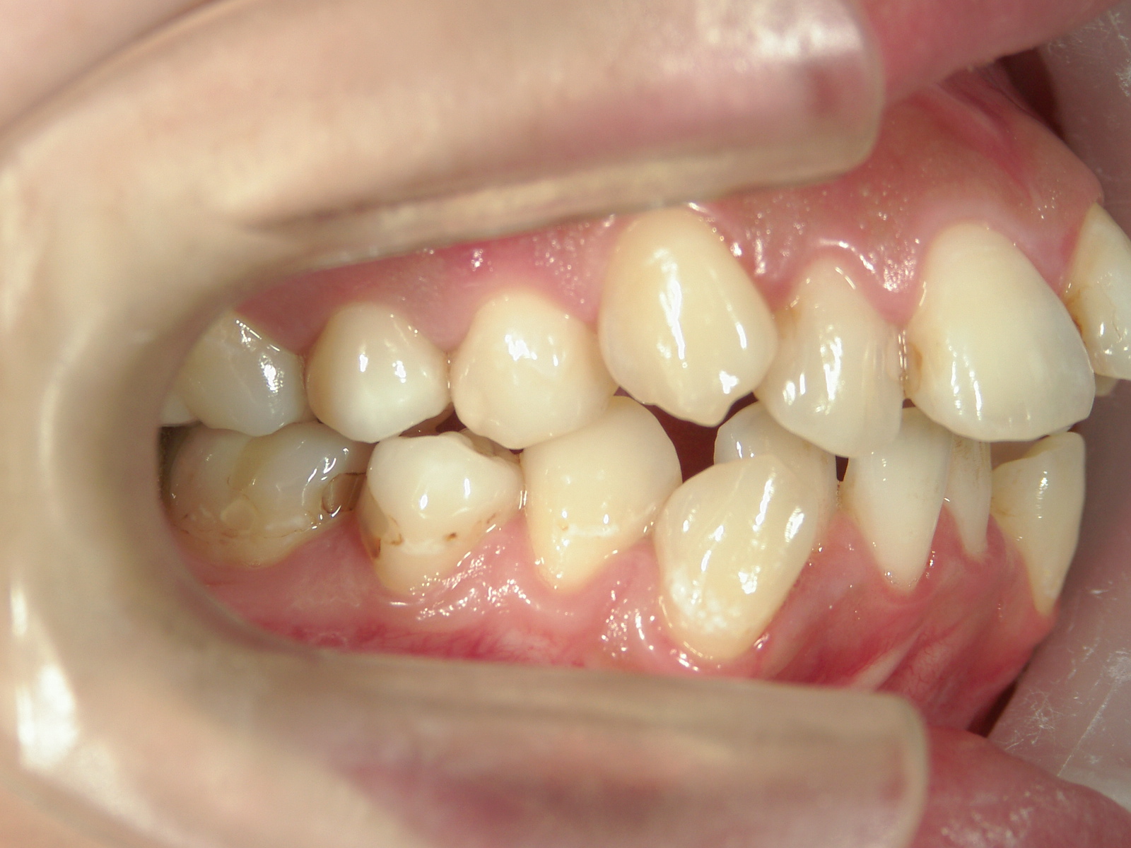 舌側ワイヤー矯正　症例（3）