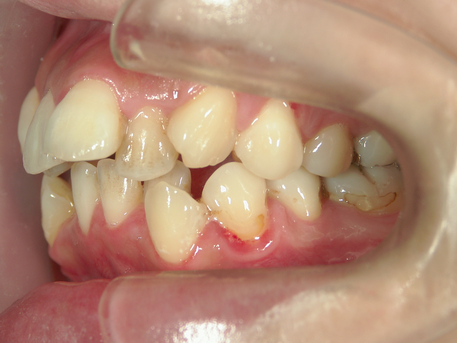 舌側ワイヤー矯正　症例（3）