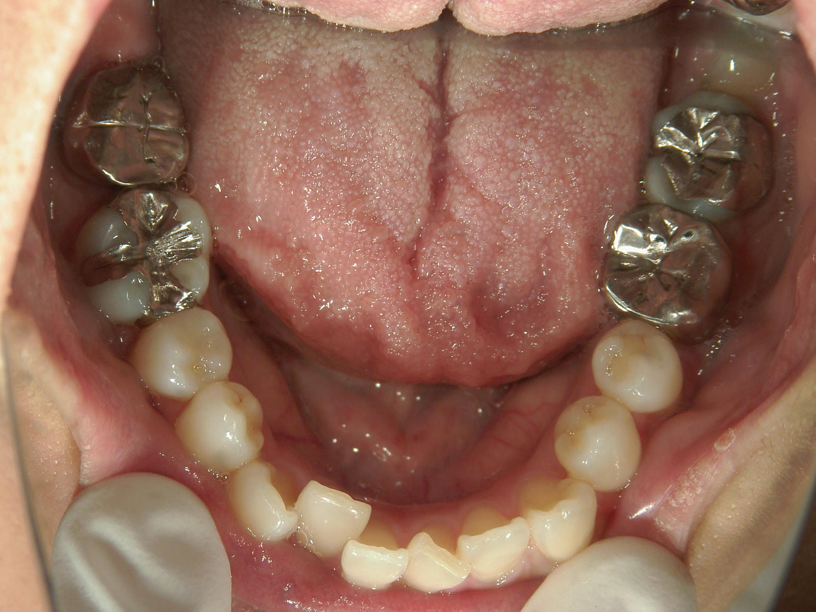 全顎ワイヤー矯正　症例（4）