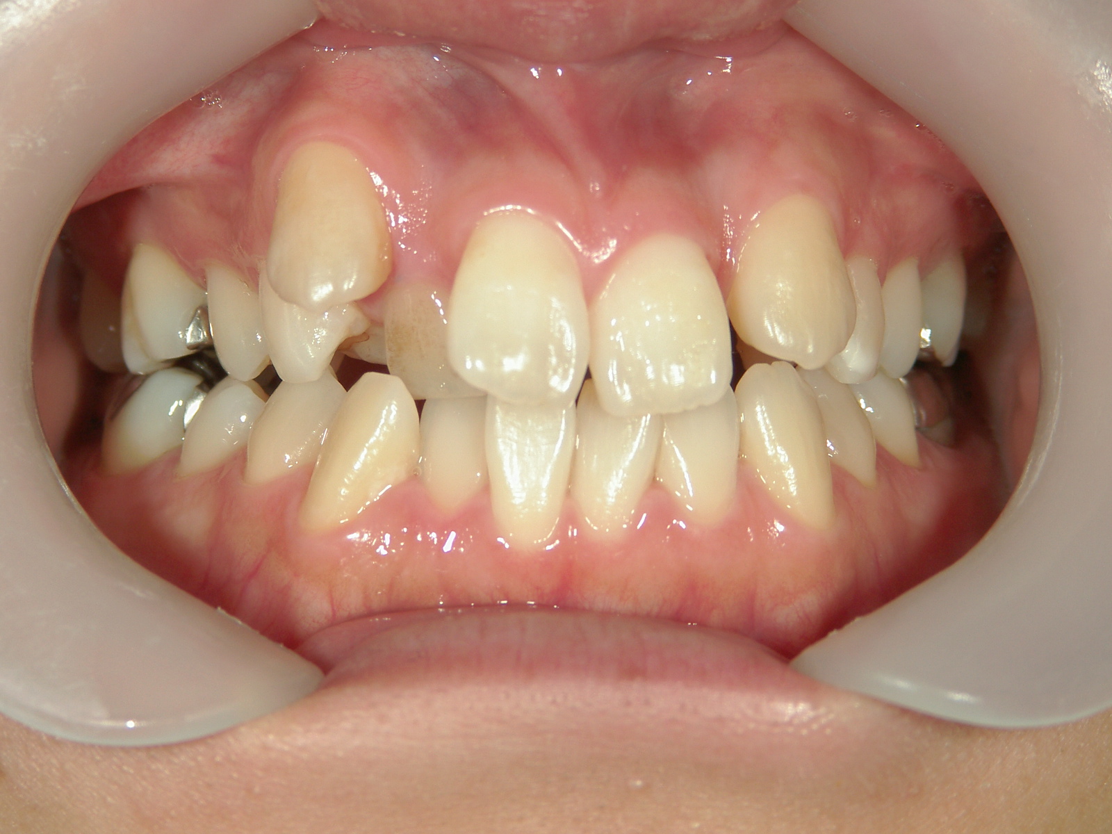 全顎ワイヤー矯正　症例（4）