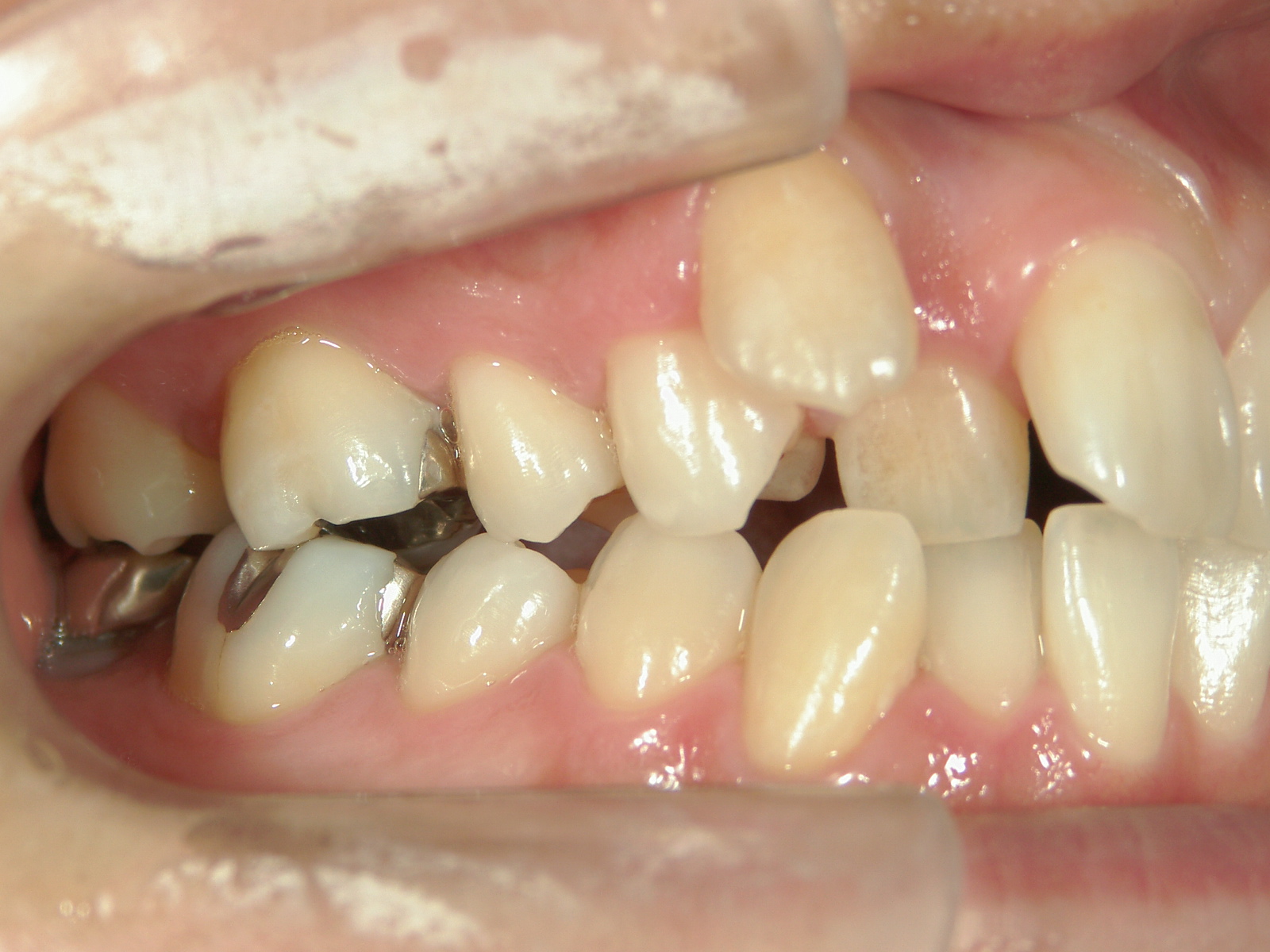 全顎ワイヤー矯正　症例（4）