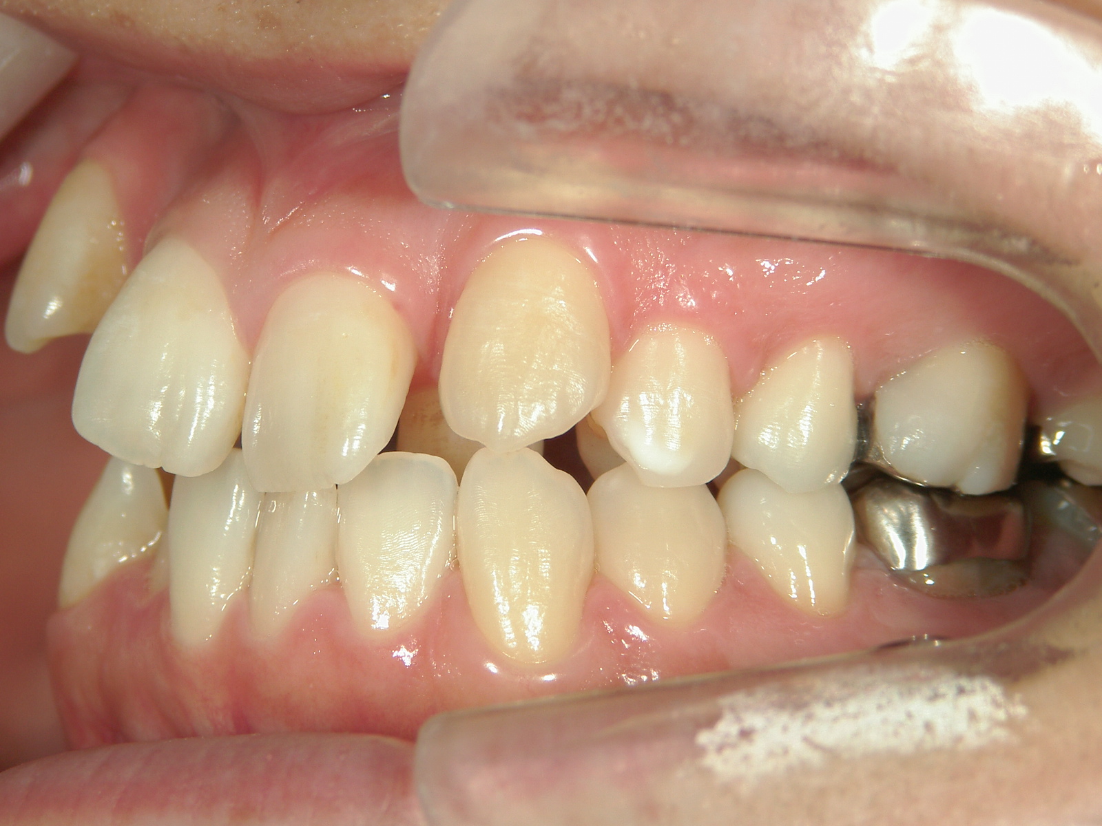 全顎ワイヤー矯正　症例（4）